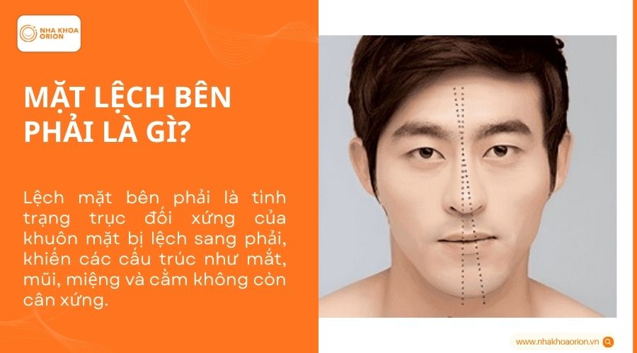 Mặt lệch bên phải là gì?
