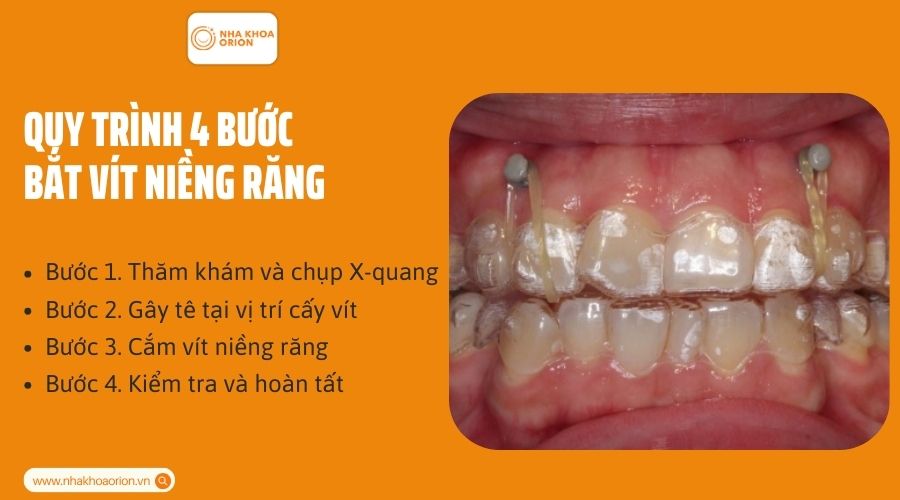 Quy tr&igrave;nh 4 bước bắt v&iacute;t niềng răng
