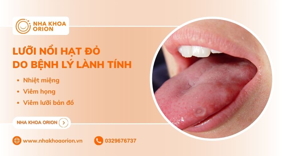 Lưỡi nổi hạt đó có thể do các bệnh lý toàn thân thông thường