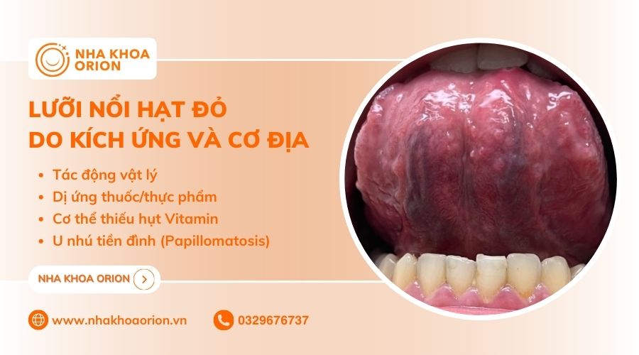 Lưỡi nổi hạt đỏ thường do cơ địa và bị kích ứng