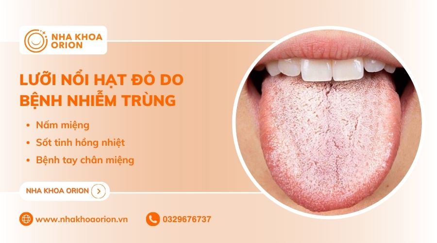 Các bệnh do vi khuẩn gây ra cũng có thể làm nổi hạt đỏ ở lưỡi