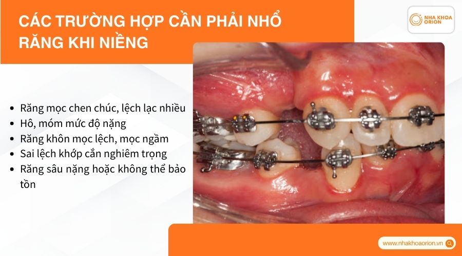 Các trường hợp cần phải nhổ răng khi niềng