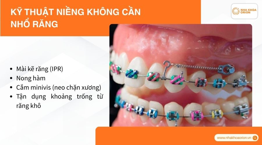 Kỹ thuật niềng không cần nhổ răng