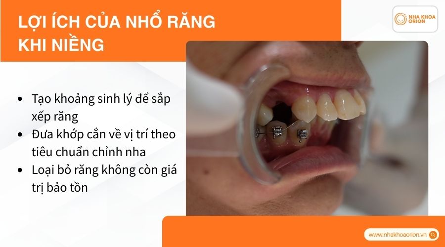 Lợi ích của nhổ răng khi niềng