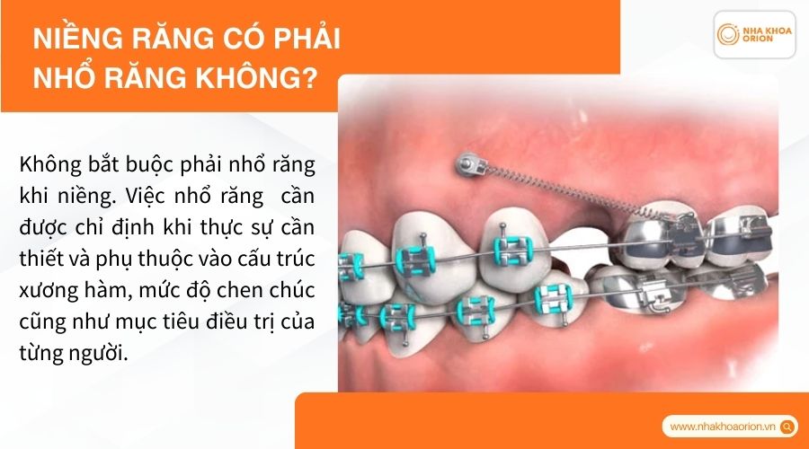 Niềng răng có phải nhổ răng không?