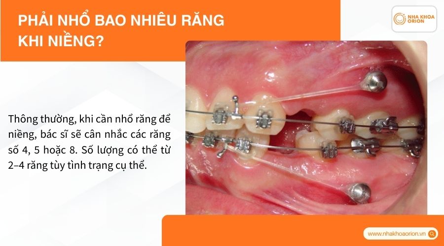 Phải nhổ bao nhiêu răng khi niềng?
