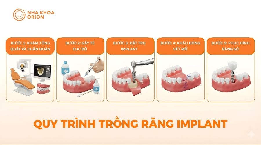Quy tr&igrave;nh trồng răng Implant cơ bản