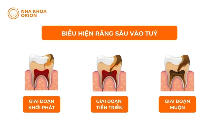 Biểu hiện sâu răng vào tủy qua ba giai đoạn