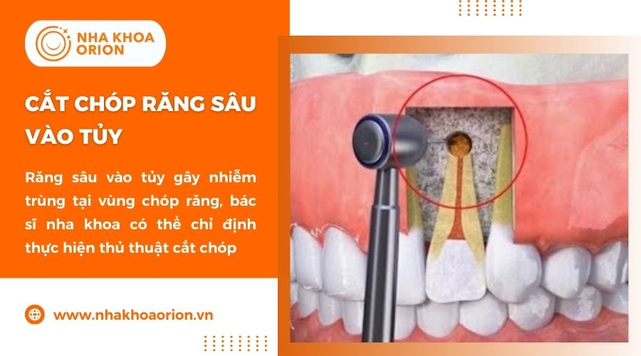 Cắt chóp răng sâu là phương pháp giúp loại bỏ nhiễm trùng vùng chóp răng