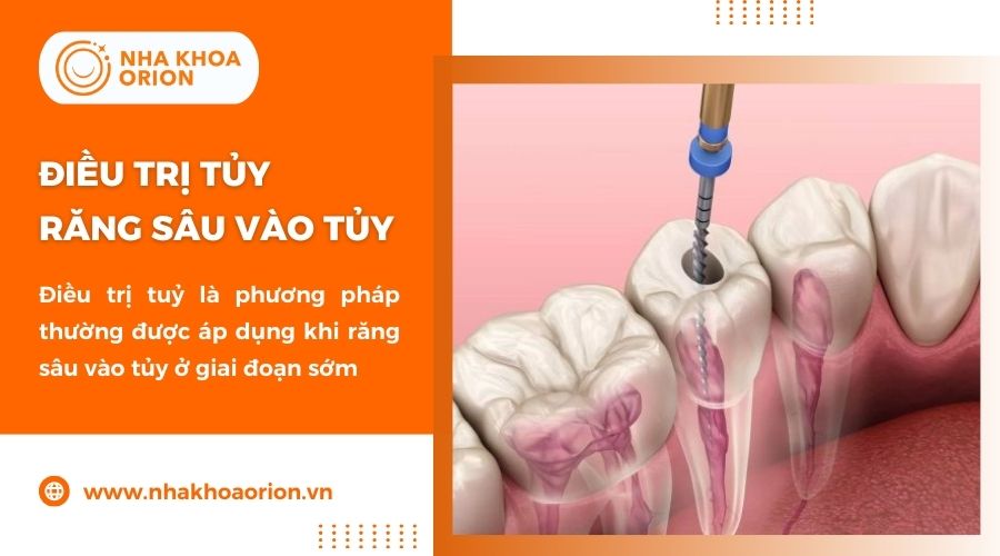 Điều trị tủy là cách hữu hiệu để xử lý viêm nhiễm mà vẫn bảo tồn răng