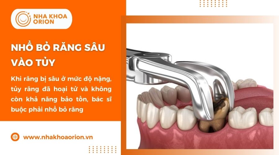 Nhổ răng là phương án cuối cùng khi răng đã sâu quá nặng