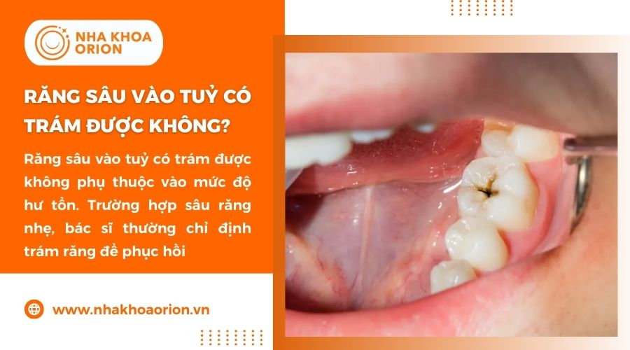 Răng sâu vào tủy có thể trám đối với trường hợp nhẹ, mới khởi phát bệnh