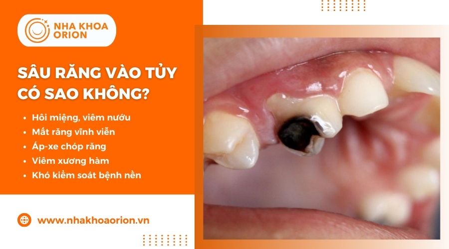 Sâu răng lan vào tủy gây ra nhiều biến chứng nguy hiểm cho sức khỏe răng miệng và toàn thân