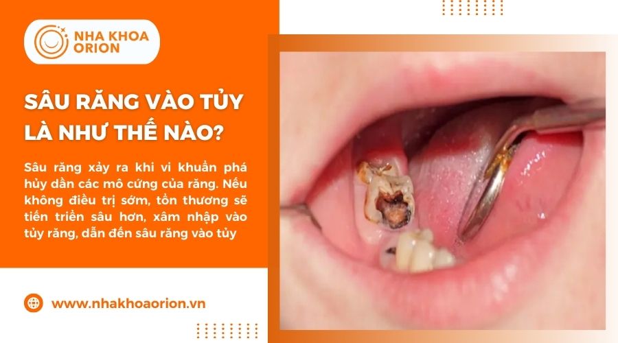 Sâu răng vào tủy là tình trạng sâu răng nặng, gây nhiễm trùng tủy