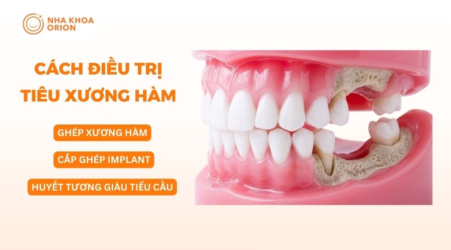 Các cách điều trị tiêu xương hàm hữu hiệu