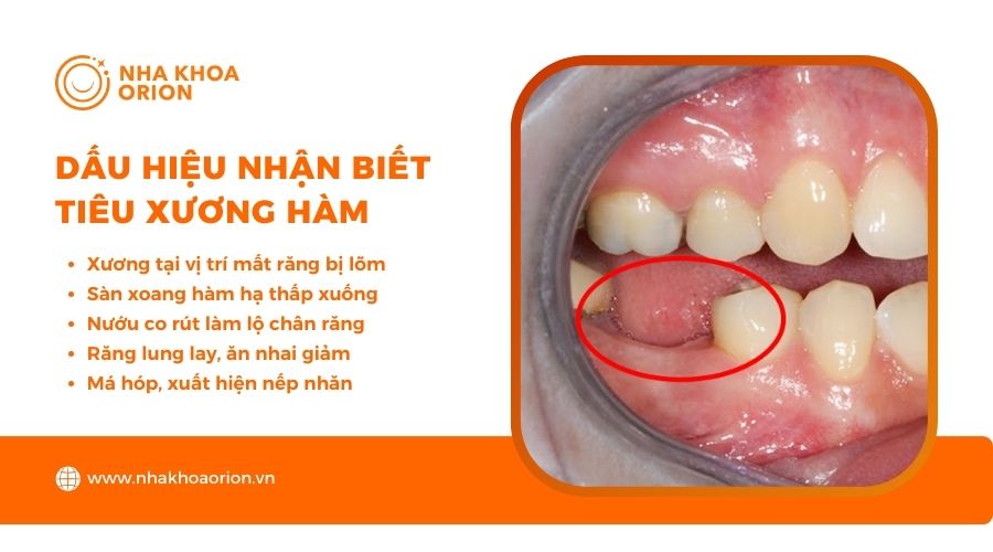 Dấu hiệu tiêu xương hàm dễ thấy nhất là vùng xương ngay răng bị mất sẽ lõm xuống