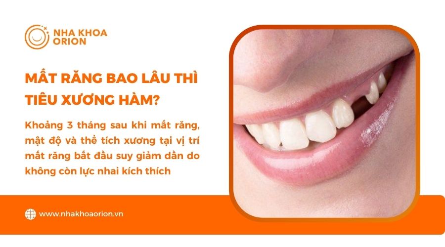 Mất răng khoảng 3 tháng sẽ bị tiêu xương hàm nếu không điều trị