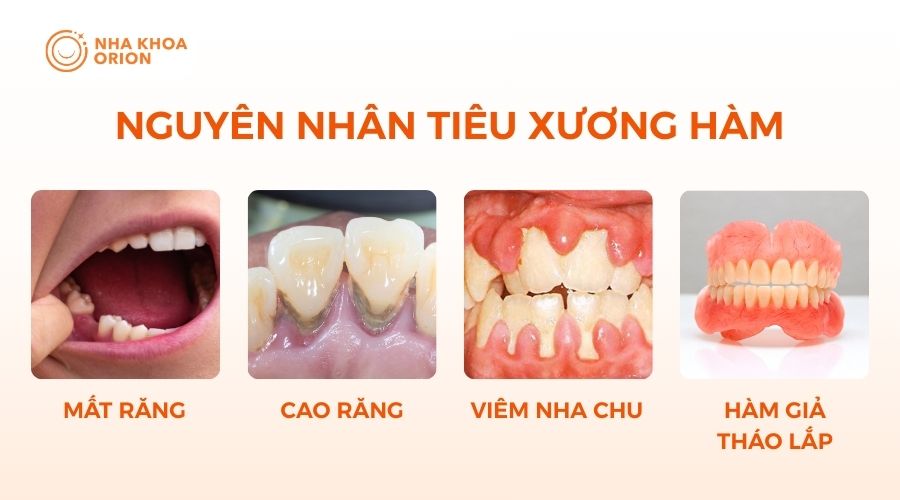 4 nguyên nhân thường gặp gây tiêu xương hàm