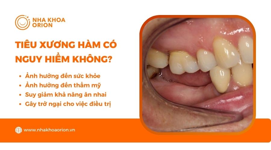 Tiêu xương hàm có thể gây nguy hiểm nghiêm trọng cho sức khỏe răng miệng