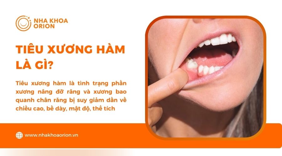 Tìm hiểu tiêu xương hàm là gì