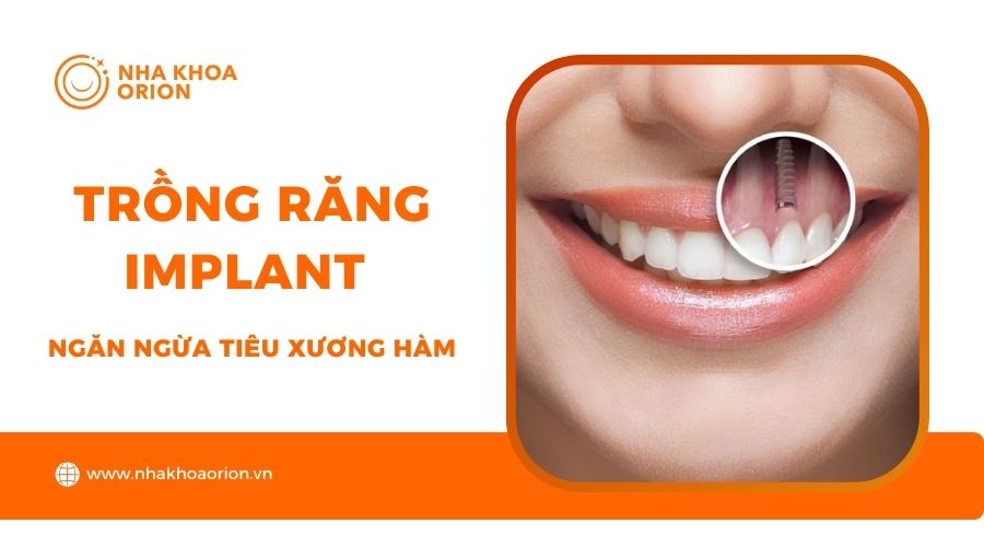 Trồng răng Implant khắc phục tiêu xương hàm