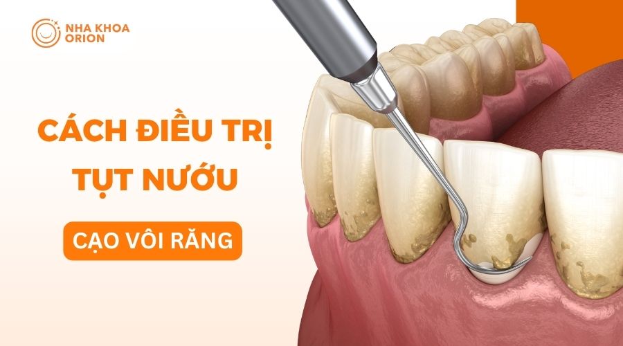 Cạo vôi răng trị tụt nướu
