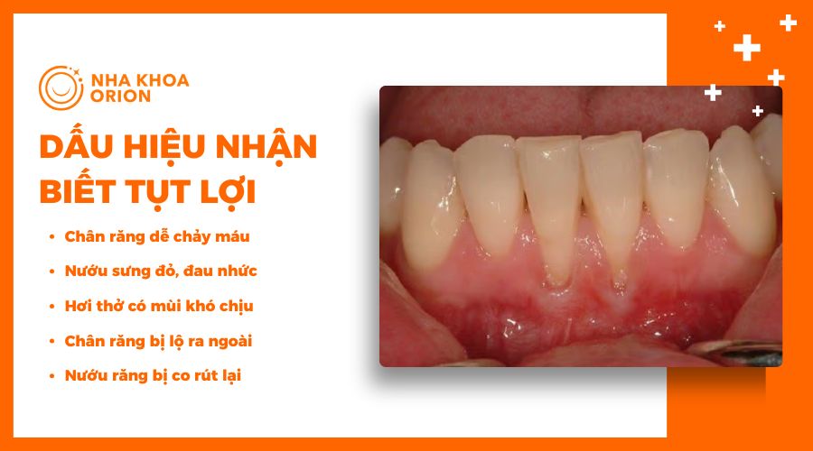 Dấu hiệu nhận biết tụt lợi dễ nhất là nướu co lại, trượt khỏi thân răng