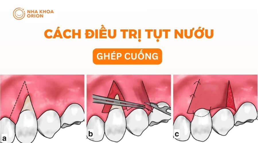 Phương pháp ghép cuống điều trị tụt nướu