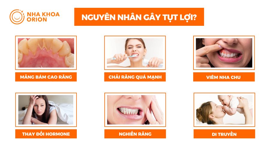 Nguyên nhân phổ biến nhất gây ra tụt lợi là cao răng