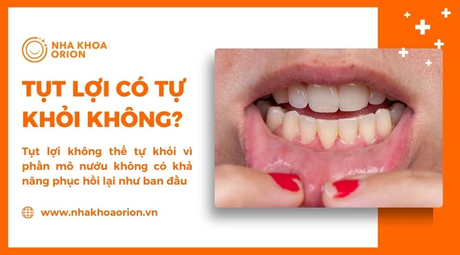 Tụt lợi không thể tự khỏi nên cần đến nha khoa điều trị
