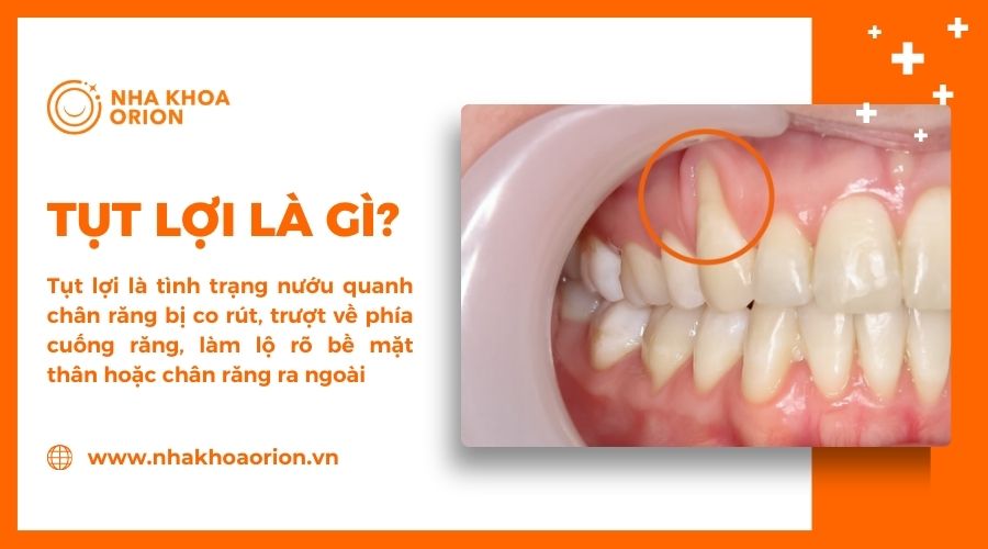 Tìm hiểu tụt lợi là gì