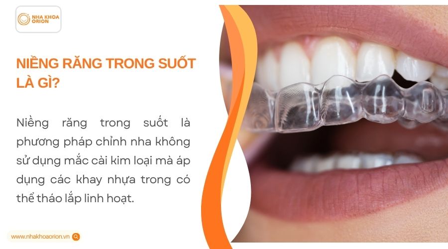Tìm hiểu về niềng răng trong suốt