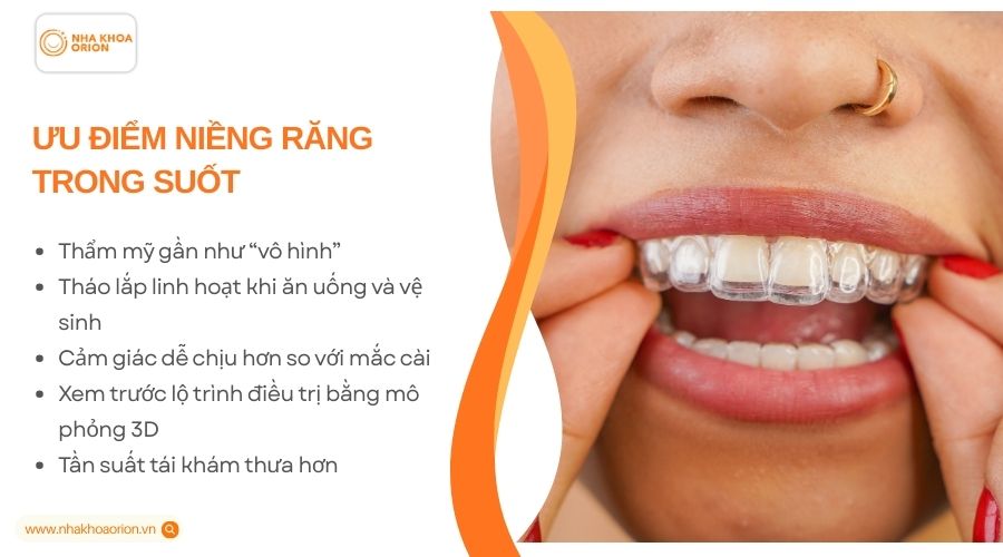 Ưu điểm khi niềng răng không mắc cài