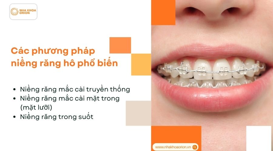 C&aacute;c phương ph&aacute;p niềng răng h&ocirc; phổ biến