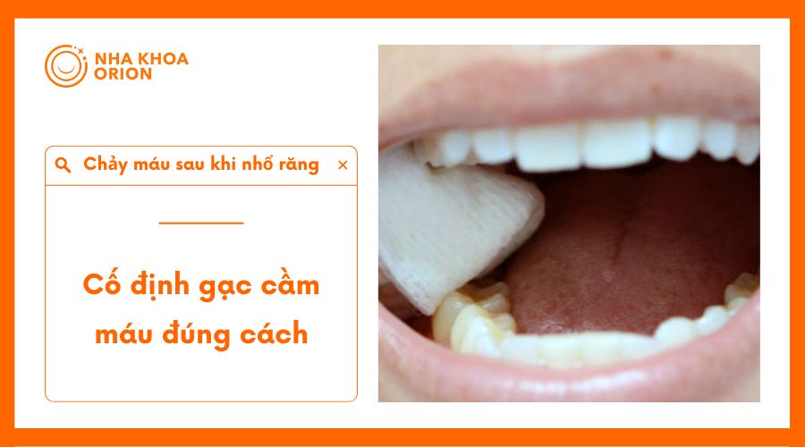 C&aacute;ch cố định băng gạc để cầm m&aacute;u sau khi nhổ răng