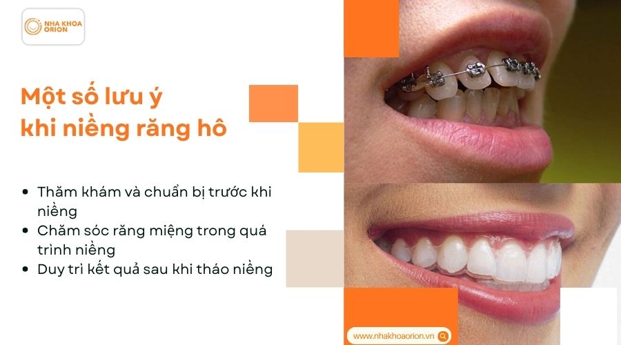 Một số lưu &yacute; khi niềng răng h&ocirc;