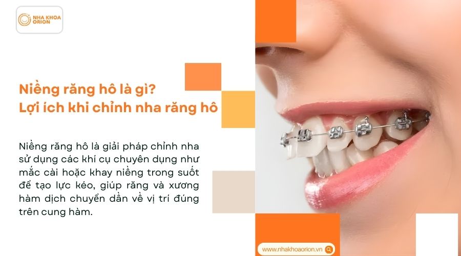 Niềng răng h&ocirc; l&agrave; g&igrave;? Lợi &iacute;ch khi chỉnh nha răng h&ocirc;