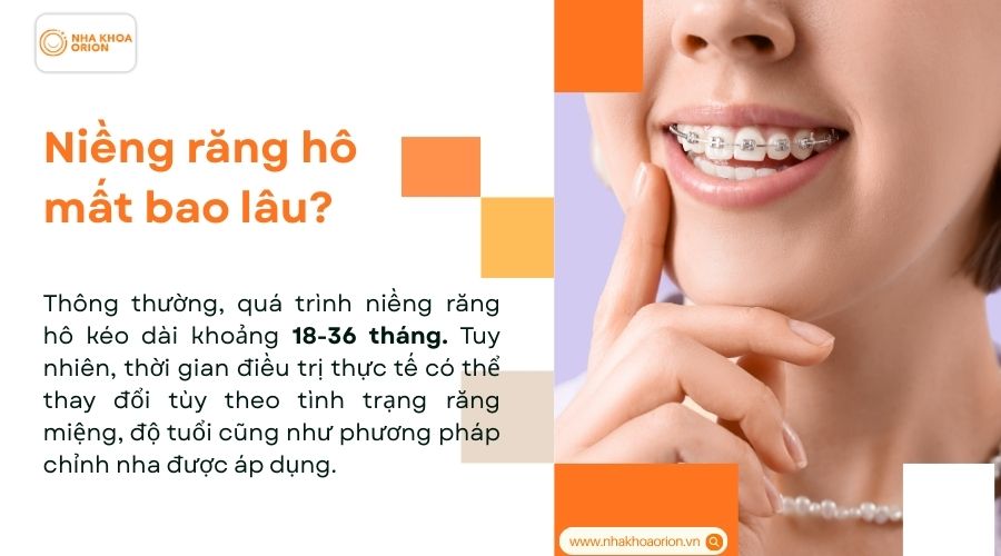 Niềng răng h&ocirc; mất bao l&acirc;u?