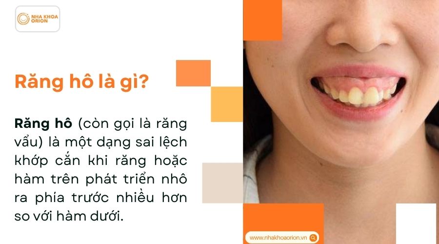 Răng h&ocirc; l&agrave; g&igrave;?