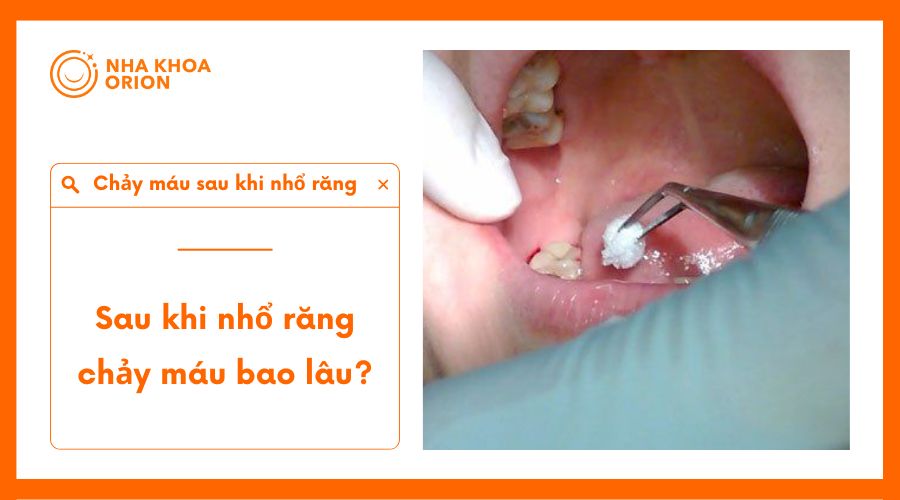 Sau khi nhổ răng baan5 sẽ bị chảy m&aacute;u nhiều nhất trong 30 - 60 ph&uacute;t đầu