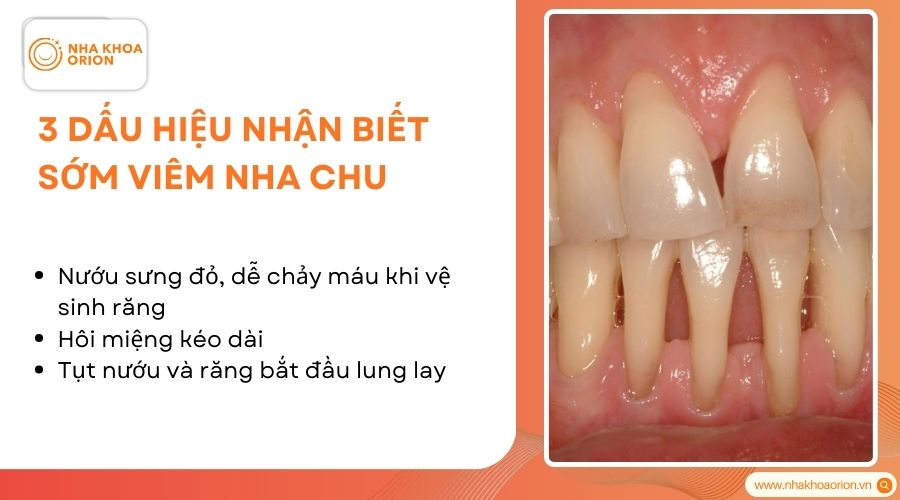 Dấu hiệu cảnh b&aacute;o vi&ecirc;m nha chu dễ nhận biết