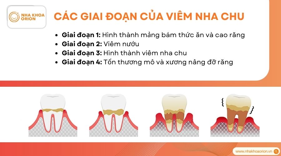 Vi&ecirc;m nha chu thường tiến triển qua 4 giai đoạn ch&iacute;nh