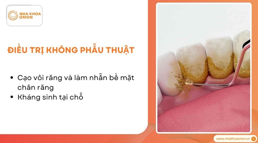 Cạo v&ocirc;i răng gi&uacute;p loại bỏ mảng b&aacute;m, hạn chế vi khuẩn t&aacute;i b&aacute;m