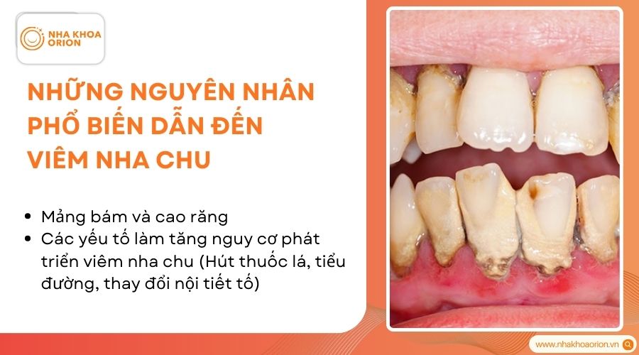 Một số nguy&ecirc;n nh&acirc;n c&oacute; thể dẫn đến vi&ecirc;m nha chu