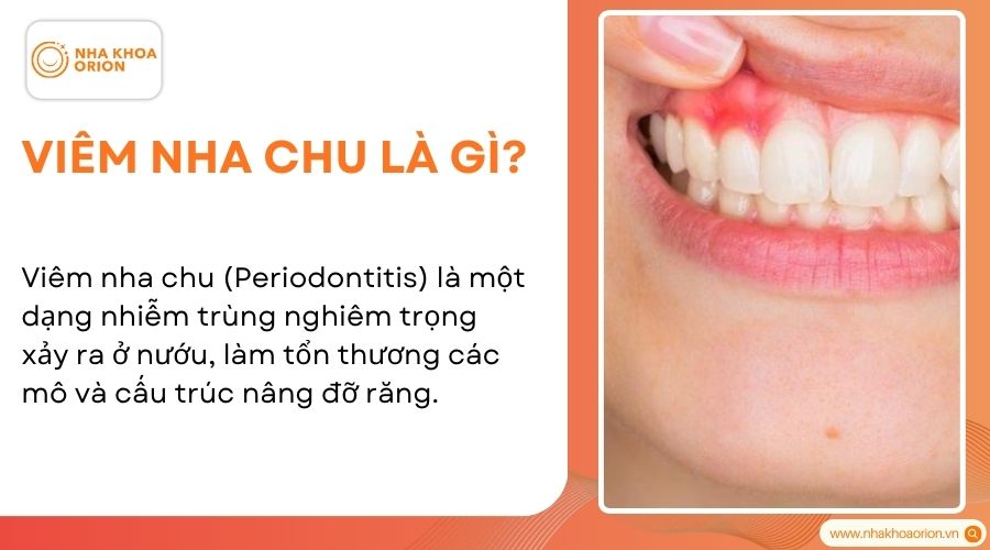 Vi&ecirc;m nha chu l&agrave; một dạng nhiễm tr&ugrave;ng nghi&ecirc;m trọng xảy ra ở nướu