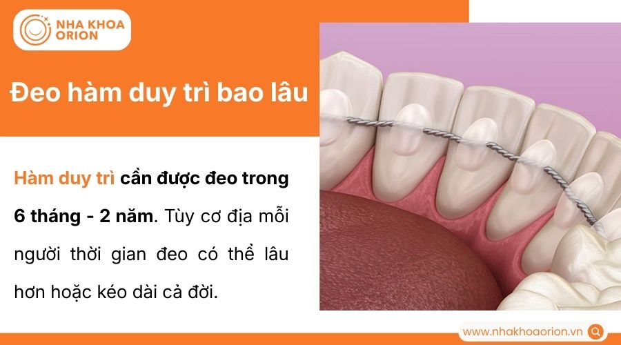 Th&ocirc;ng thường h&agrave;m duy tr&igrave; cần được đeo từ 6 th&aacute;ng đến 2 năm