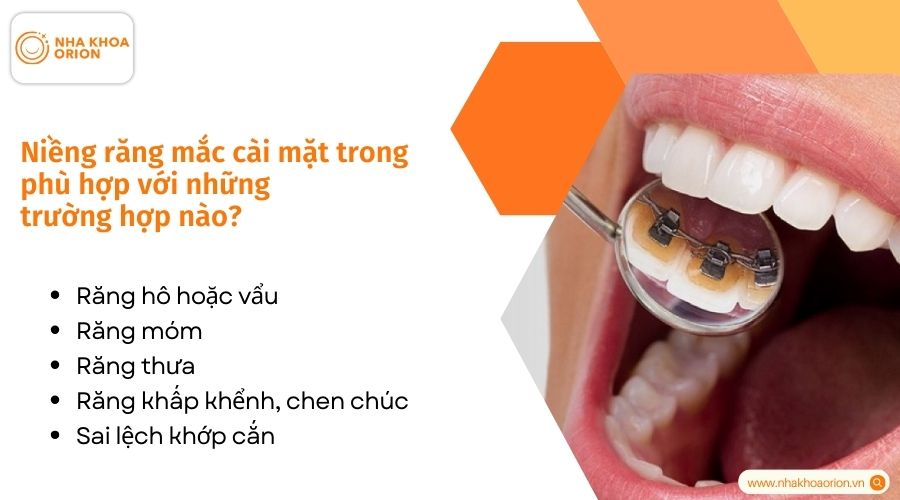 Niềng răng mắc c&agrave;i mặt trong ph&ugrave; hợp với những trường hợp n&agrave;o?