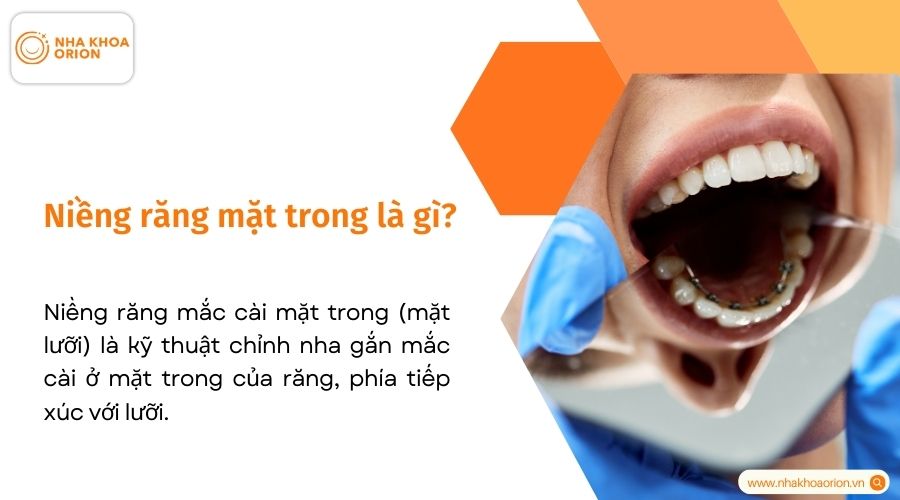Niềng răng mặt trong l&agrave; g&igrave;?