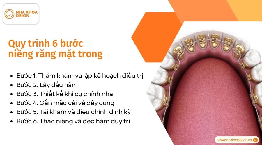 Quy tr&igrave;nh 6 bước niềng răng mặt trong