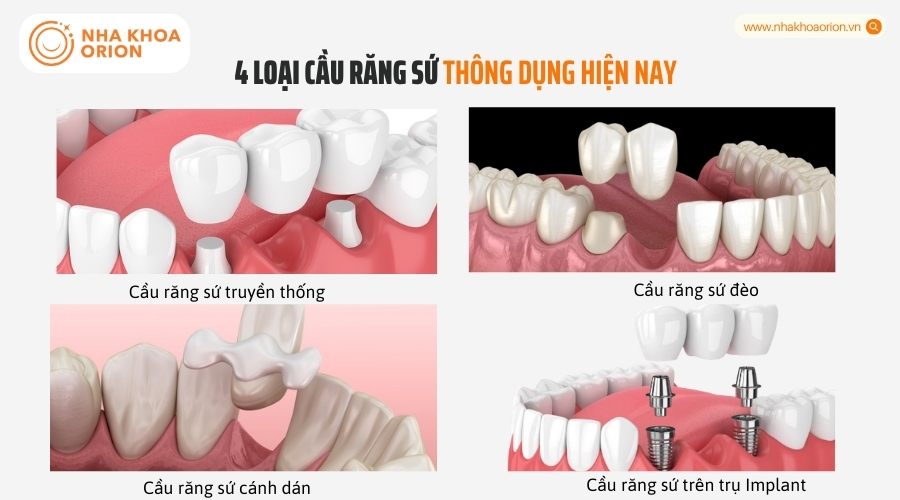4 loại cầu răng sứ th&ocirc;ng dụng hiện nay